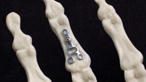 Hand Fracture Fixation Course 2027