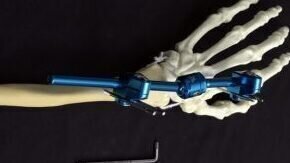 Wrist Fracture Fixation - 2027