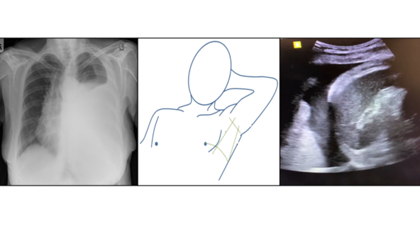 Lung Ultrasound and Chest, Intercostal Drain (LUCID)