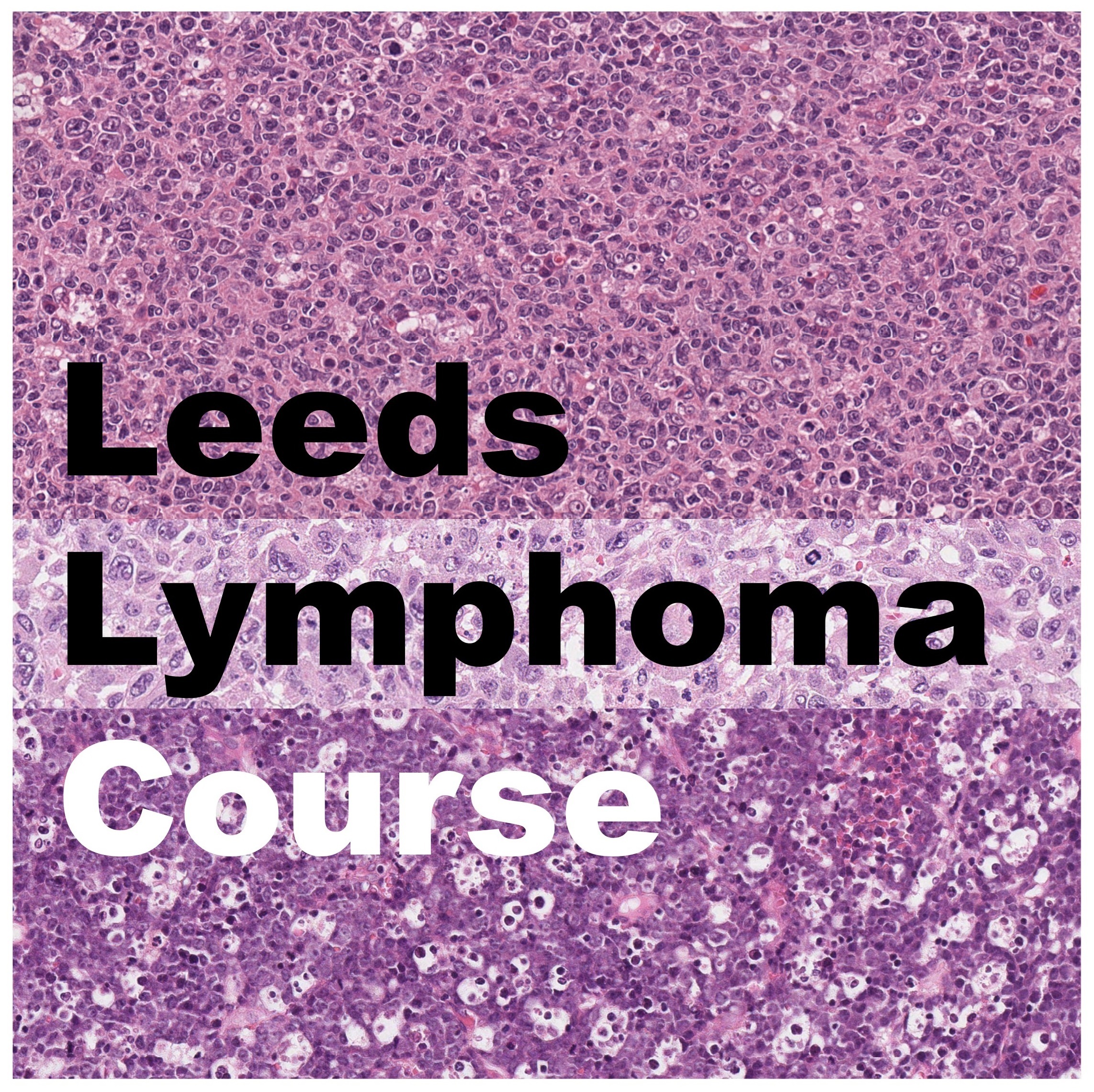 Leeds Lymphoma Course